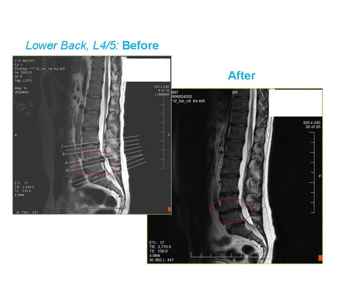 Anatomical diagram showing disc herniation at L4-L5 level in the lumbar spine